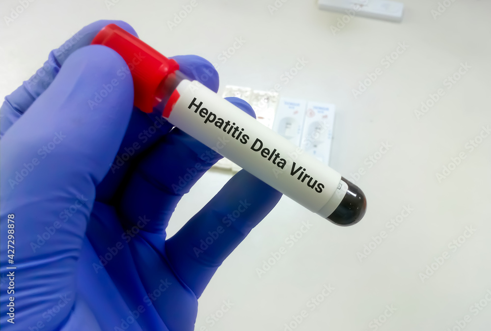 Obraz premium Blood sample for hepatitis Delta virus test