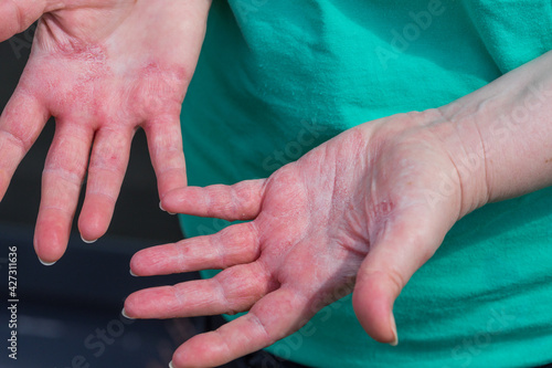 Atopic dermatitis, The woman looks at red and chapped hands with severe allergies