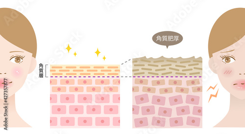 角質肥厚　健康な肌　断面図と女性　