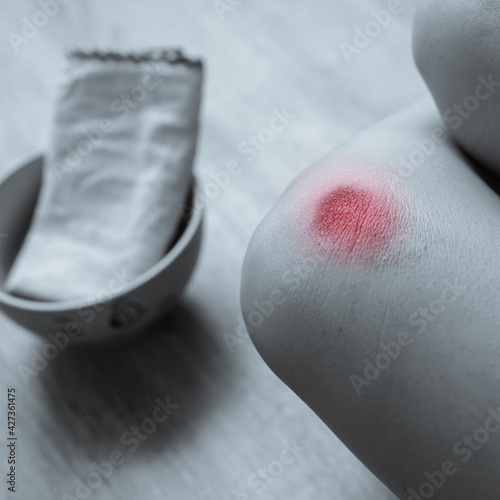 Black and white photo of young woman with large wound on knee photo