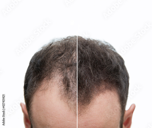 Vorher Nachher - Halbglatze eines Mannes mit Haarausfall	von vorne photo