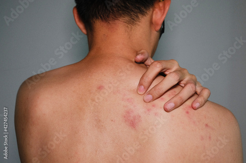 Close up view of man scratching his back .Painful back skin rash with blisters in a limited area.A man who having varicella blister ,  chickenpox,Herpes zoster or Shingles.