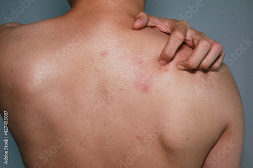 Close up view of man scratching his back .Painful back skin rash with blisters in a limited area.A man who having varicella blister , chickenpox,Herpes zoster or Shingles.