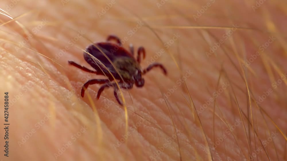 Macro Video of Encephalitis Tick Insect Crawling on Human Skin. Encephalitis Virus or Lyme Borreliosis Disease Infectious Dermacentor Tick Arachnid Parasite. Macro Video of Encephalitis Tick Insect Crawling on Human Skin. Encephalitis Virus or Lyme Borreliosis Disease Infectious Dermacentor Tick Arachnid Parasite.