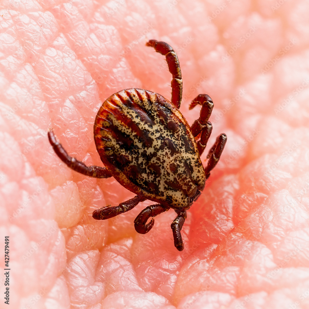Infectious Encephalitis Tick Insect on Skin. Encephalitis Virus or Lyme Borreliosis Disease Infected Dermacentor Tick Arachnid Parasite Bite. Infectious Encephalitis Tick Insect on Skin. Encephalitis Virus or Lyme Borreliosis Disease Infected Dermacentor Tick Arachnid Parasite Bite.