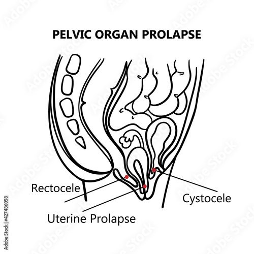 PELVIC ORGAN PROLAPSE MONOCHROME Of Women General Diagram With Explanatory Text For Medical Education Clip Art Vector Illustration Set For Print