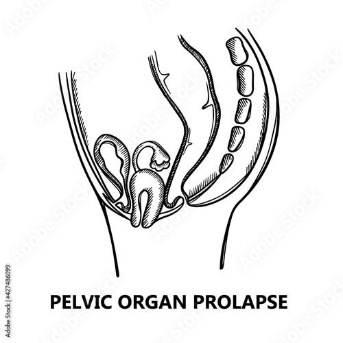 PELVIC ORGAN PROLAPSE SKETCH Of Women Monochrome General Diagram For Medical Education Clip Art Vector Illustration Set For Print