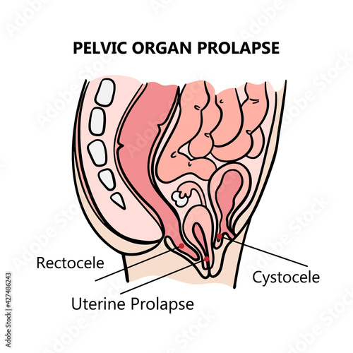PELVIC ORGAN PROLAPSE Of Women General Diagram With Explanatory Text For Medical Education Clip Art Vector Illustration Set For Print