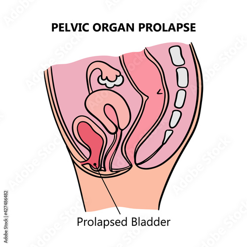 PROLAPSED BLADDER Of Women General Diagram With Explanatory Text For Medical Education Clip Art Vector Illustration Set For Print