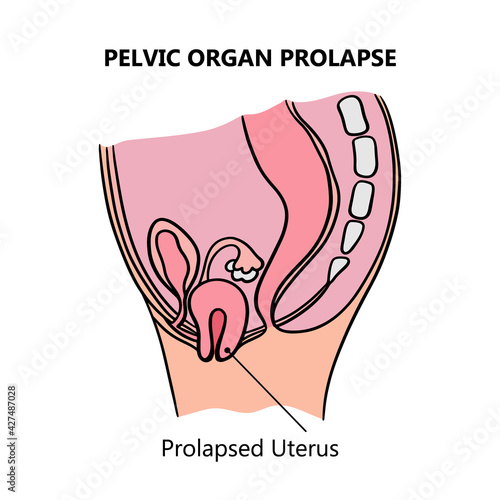 PROLAPSED UTERUS Of Women General Diagram With Explanatory Text For Medical Education Clip Art Vector Illustration Set For Print