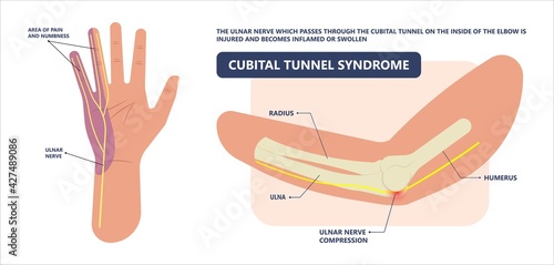 ulnar nerve muscle bone elbow swollen pain hand palm bone spurs ring little medial golfer radial arms wrist funny carpal tennis canal palsy test