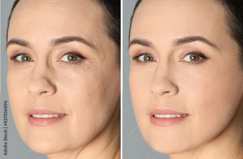 Collage with photos of mature woman before and after biorevitalization procedure on grey background Collage with photos of mature woman before and after biorevitalization procedure on grey background