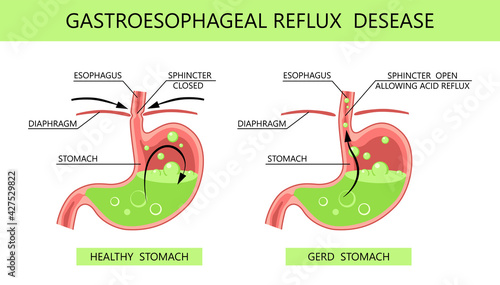 Gastroesophageal reflux disease. Acid reflux, heartburn and gerd infographic with medical vector illustration. Healthy and sick stomach. Medicine anatomy healthy, organ and illness GERD infographic photo