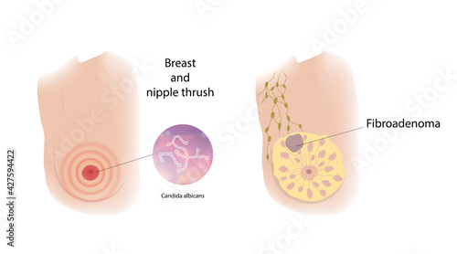 Woman breast and nipple thrush, Fibroadenoma. Comparison. Medical vector illustration.
