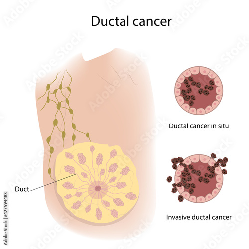 Woman breast. Ductal cancer. In situ, Invasive view with description. Medical vector illustration.