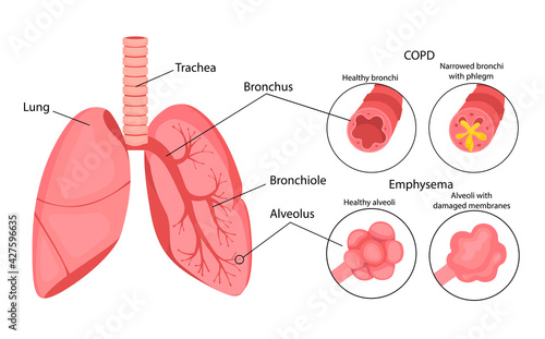 COPD (chronic obstructive pulmonary disease). Emphysema of the lungs. Lung disease. Infographics. Vector illustration in cartoon style isolated on white background.