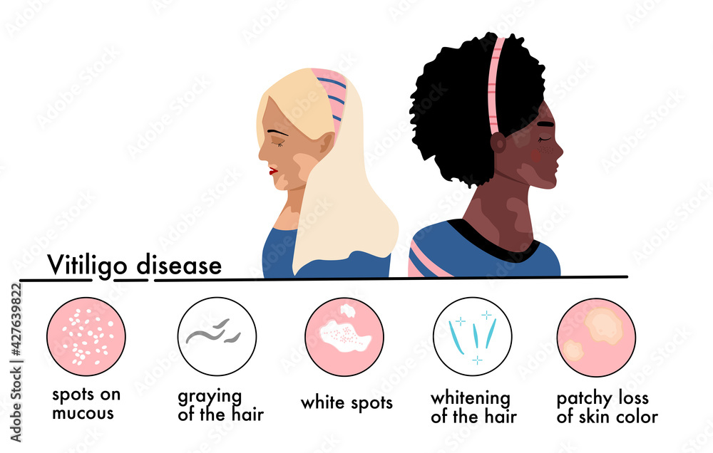 World Vitiligo Day Young Women Different Ethnicities With Skin Disease World Vitiligo Day Young Women Different Ethnicities With Skin Disease