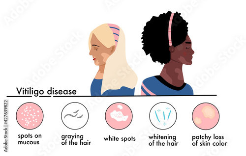 World vitiligo day.Young women different ethnicities with skin disease.Depigmentation problem.Patchy loss of derma color.Infographics icons with symptoms and signs of autoimmune sickness.Vector banner