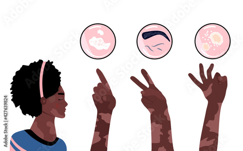 World vitiligo day.Young afro american woman with skin disease.Hands show 1,2,3 fingers. Pigmentation problem.Patchy loss of derma color. Infographics icons with symptoms,signs of autoimmune sickness