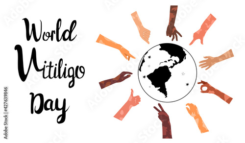World vitiligo day poster with lettering.Hands different ethnicities in various gestures with skin disease. Depigmentation problem. Patchy loss of derma color. Autoimmune sickness. Human Solidarity.