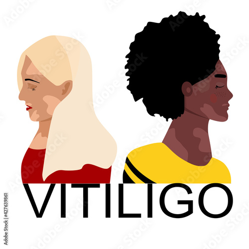 World vitiligo day.Young women different ethnicities with skin disease. Depigmentation problem. Patchy loss of derma color.Autoimmune sickness. Vector illustration for medical holiday.Body positive.