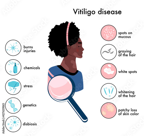 World vitiligo day.Infographics icons with symptoms and reasons of autoimmune sickness.Skin disease.Afro american woman with white spots.Depigmentation problem.Patchy loss of derma color.Vector banner