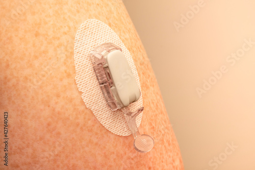 CGM - Continuous glucose monitoring: sensor installation on the upper arm. Sensor pod. transmitter and transmitter latch photo