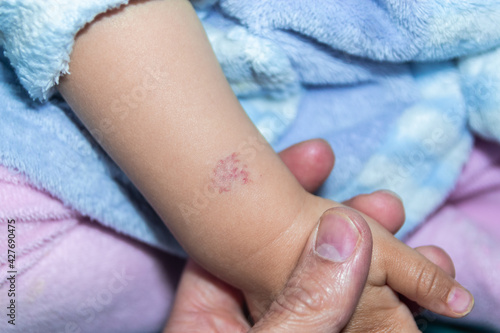 Angioma or pink hemangioma on the arm of a fifteen month old baby photo