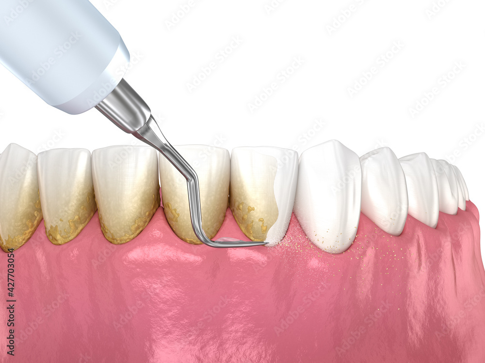 Oral hygiene Scaling and root planing (conventional periodontal