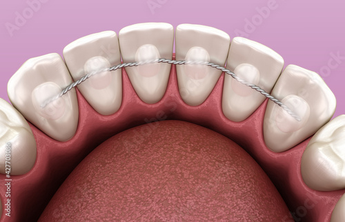 Retainers dental installed after braces treatment, Medically accurate dental 3D illustration photo