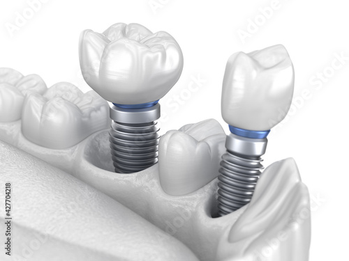 Bild auf Leinwand Premolar and Molar tooth crown installation over implant - white concept