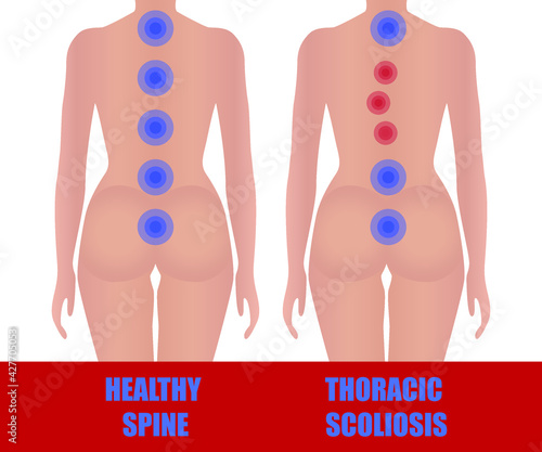 Thoracic scoliosis. Curvature of the spine. Image of the girl's uneven back. Comparisons with a healthy back. Medical educational poster.