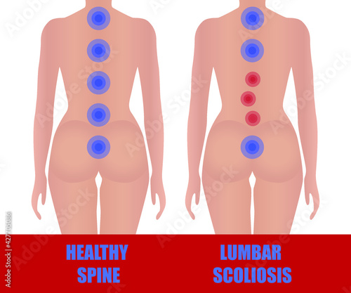 Lumbar scoliosis. Image of a healthy and uneven back of a girl. Medical educational poster on the subject of curvature of the spine.