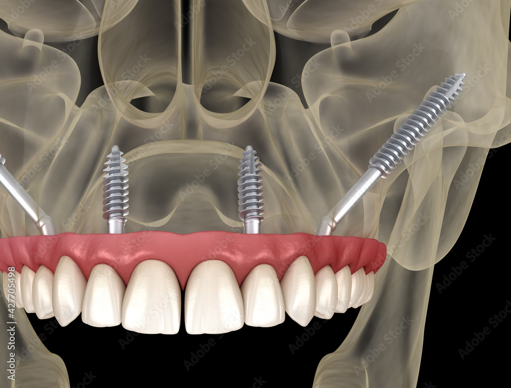 Maxillary Prosthesis Maxillary prosthesis supported by zygomatic implants. Medically ...