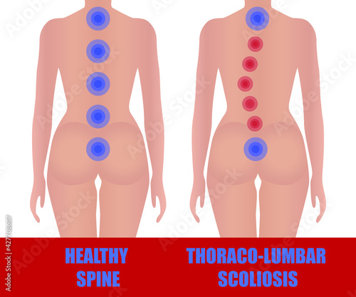 Thoracolumbar scoliosis. Image of a healthy and uneven back of a girl. Medical educational poster. Curvature of the spine. 