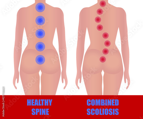 Combined scoliosis. Image of a healthy and uneven back of a girl. Medical educational poster. Curvature of the spine. 