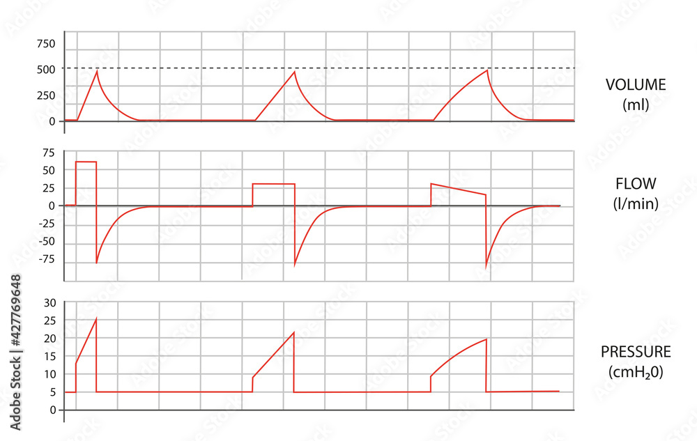 Mechanical Ventilation waves. Volume, flow and pressure curves from a mechanical Ventilator. 
