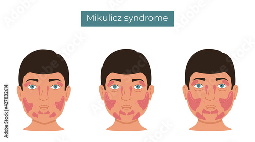 Vector illustration of Mikulicz syndrome. Enlargement of the lacrimal and salivary glands. photo