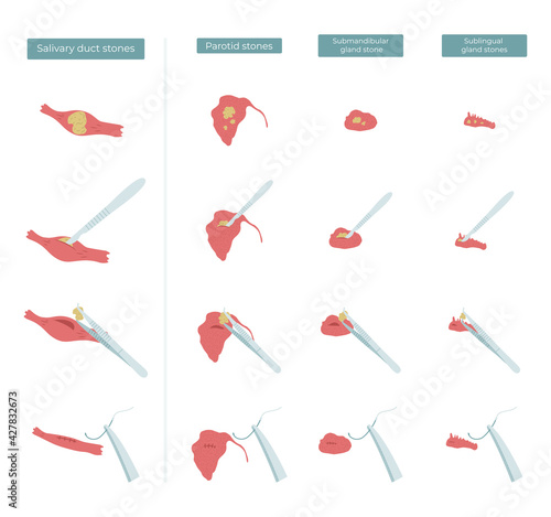 Vector flat illustration of surgery to remove stones from the parotid, submandibular and sublingual salivary glands. photo