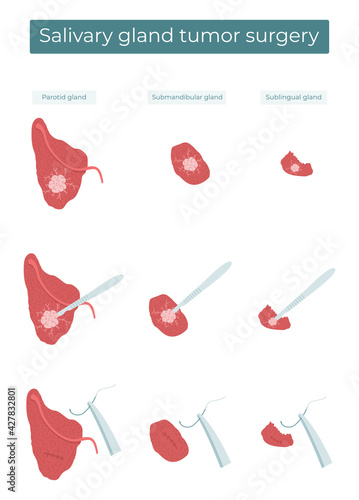 Vector flat illustration of surgical removal of a tumor from the parotid, submandibular, and sublingual salivary glands.