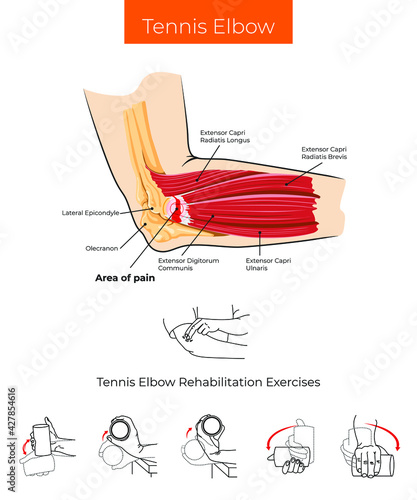 Vector illustration. Tennis Elbow and Tennis Elbow Rehabilitation Exercises 