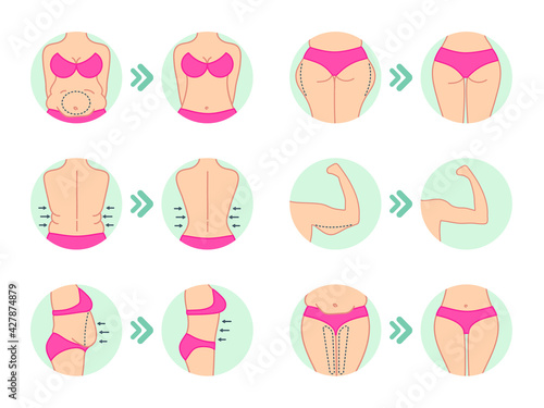 Liposuction. Liposuction hips, stomach. Removal of fat. Plastic surgery. Stock vector.