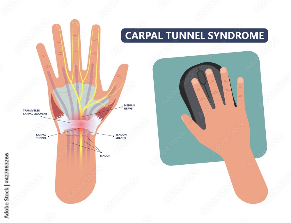 Carpal Tunnel Syndrome pain hand arm wrist splint surgery bone flexor  fingers thumb muscle Brace index middle ring work limb palm mouse keyboard  vector de Stock | Adobe Stock