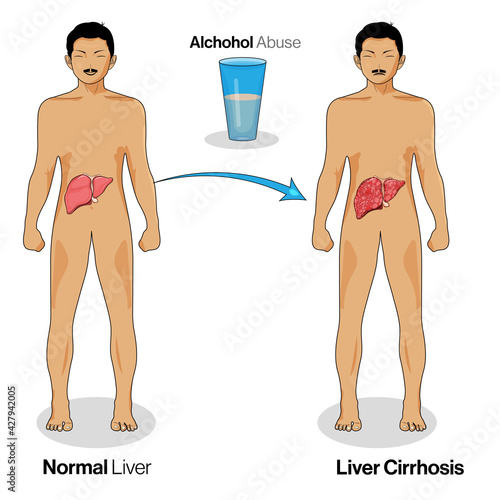 Illustration of liver cirrhosis due to alcohol abuse.