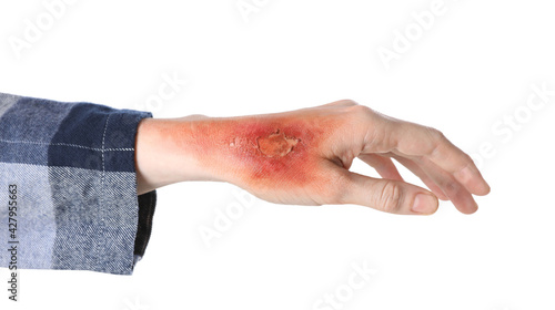 Fotografi Woman with burn on her hand against white background, closeup