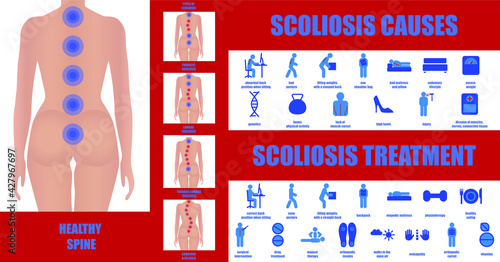 Scoliosis infographics. A set of icons on the topic of the causes and treatment of scoliosis. Curvature of the spine. Image of a healthy and uneven back of a girl. Medical educational poster.