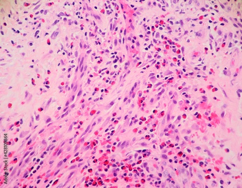 Foto Vascular lesion known as angiolymphoid hyperplasia with eosinophilia