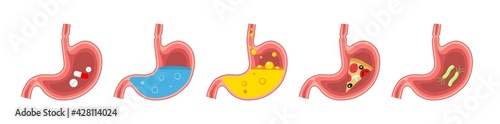 Set of healthy and sick stomach. Stomach pain, gastritis, indigestion, vomiting, heartburn problem. Digestive system.Medicine anatomy human stomach.Vector flat illustration isolated on white backgroun