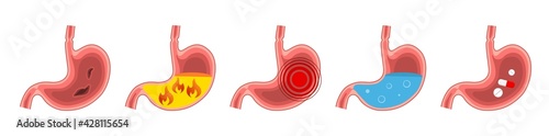 Set of healthy and sick stomach. Stomach pain, gastritis, indigestion, vomiting, heartburn problem. Digestive system.Medicine anatomy human stomach.Vector flat illustration isolated on white backgroun