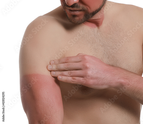 Man with sunburned skin on white background  closeup